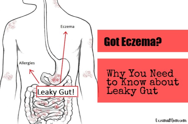 Chinese medicine for Eczema- Not the skin but the Gut and Hormone!